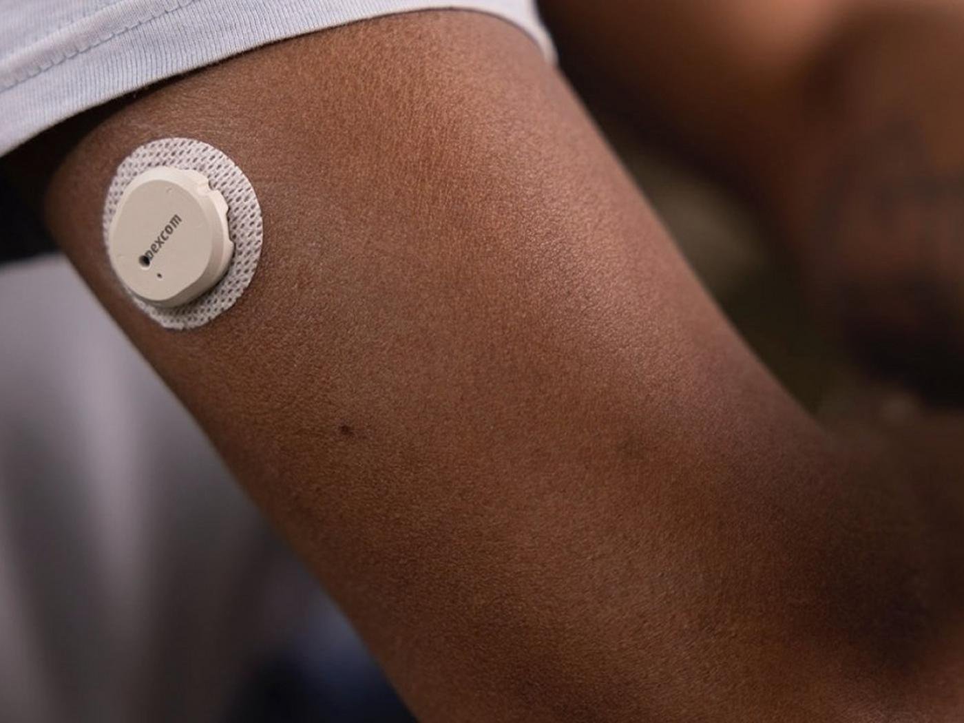 Sensor Dexcom G7 — fotografía oficial Dexcom